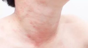 Аллергия с волдырем на метронидазол