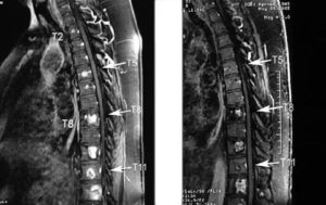 Метастазы в шейном отделе позвоночника? Или все-таки нет?