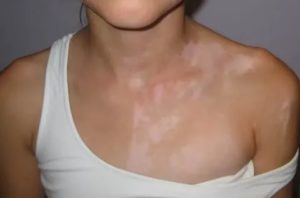 Пегментное пятно от загара у ребенка