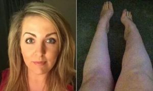 Контрацептивы и отёки