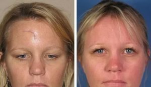 Можно ли иссечь атрофический рубец на носу?