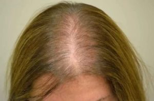 От приёма джес выпадают волосы что делать?