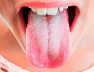 Налет на языке с неприятным запахом