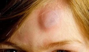 Красная шишка на лбу