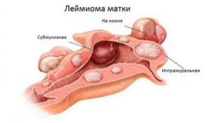 Субфебриллитет миома