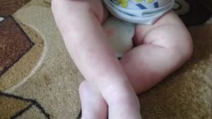 Может ли быть аллергия на супрастин?