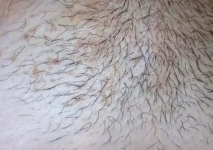 Ранки на лобке