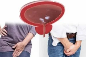 Тяжесть в животе, частое мочеиспускание