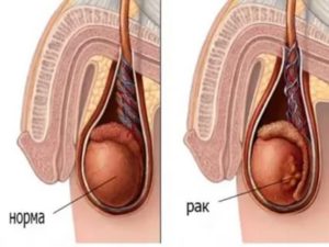 Шишка под яичком
