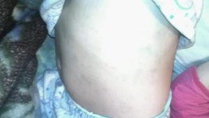 Сыпь и зуд до крови у ребенка