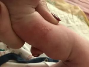 Аллергия у ребенка только между ножек