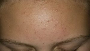 Мелкие прыщи на коже подростка