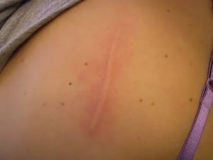 Сыпь в виде царапин