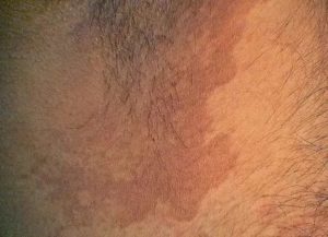 Покраснение и рубцы в паху