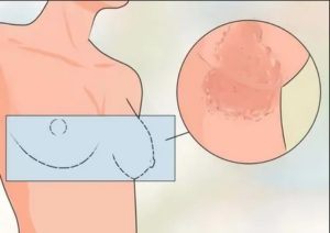 Зуд и покраснение в ложбинке груди