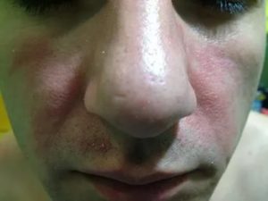 Пятно на носу шелушится