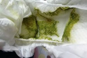 Жидкий стул полгода