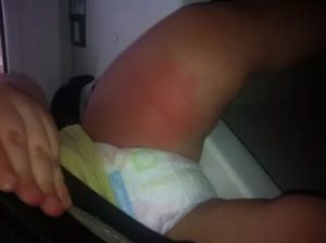 Уплотнение на бедре ребенка