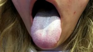 Тёмный налёт на языке ангина насморк