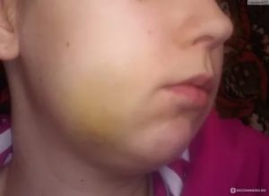 Опухлость щеки, синяк после пломбирования зуба