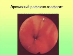 Рефлюкс эзофагит 1степени, поверхностный гастрит и деуденит