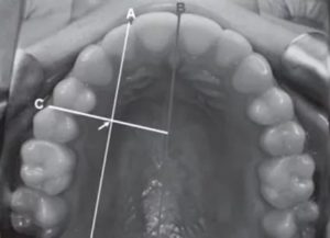 Рыбная кость уколола десну