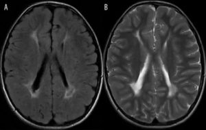 Нейройнфекция, очаги глиоза в лобной доли