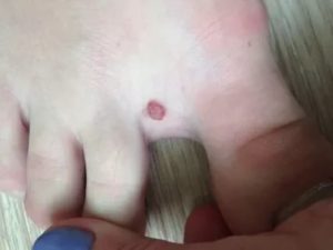 Удаленная родинка между пальцев мокнет