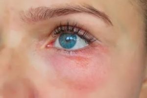 Красное пятно на нижнем веке