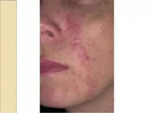 Розоцеа после отмены Акридерма