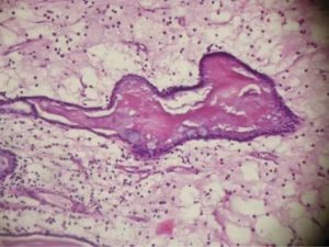 Гистология после удаления полипа