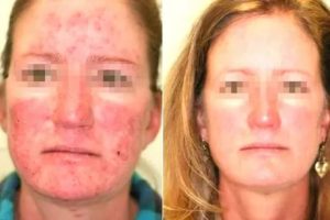 Розоцеа после отмены Акридерма