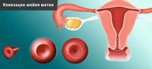 Месячные после конизации шейки матки
