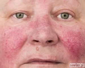 Розацеа-розовые угри