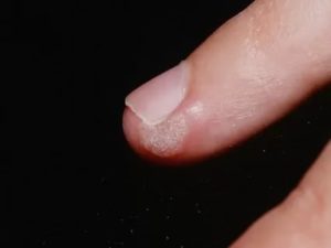 Сухой нарост на пальце руки около ногтя