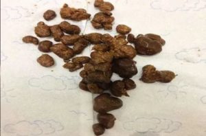 Сухой кал у ребенка