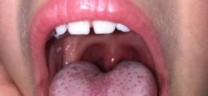 Хронический фарингит, на корне языка бугорки