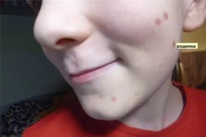 Пятно на подбородке