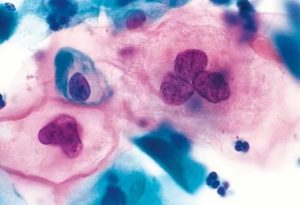 Цитологическое исследование. Паракератоз плоского эпителия