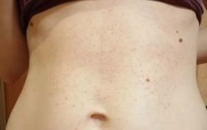 Сыпь под молочными железами, на шее, животе