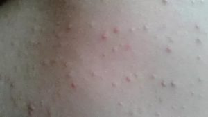 Сыпь на попе у подростка