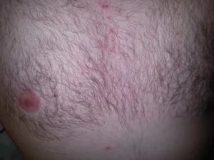 Зуд и покраснение в ложбинке груди