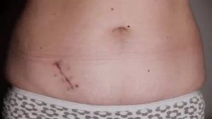 Разрастается шрам после аппендицита