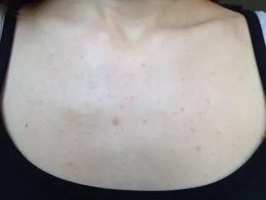 Мелкая сыпь по всему лицу и шее