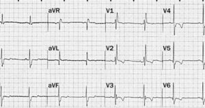 Ишемия ритма ST-T