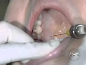 Рыбная кость уколола десну