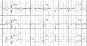 Ишемия ритма ST-T