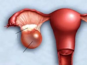 Горят яичники