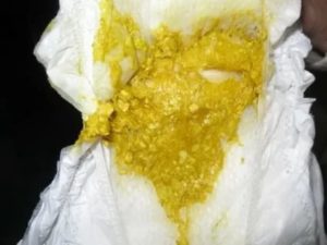 Сухой кал у ребенка