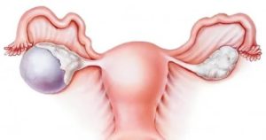 Горят яичники